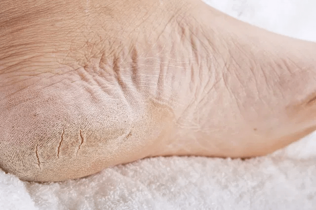 Rachaduras nos Pés: Saiba Como Prevenir e Tratar Esse Problema Comum